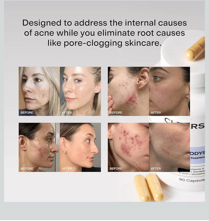 Hormonal Acne Supplement