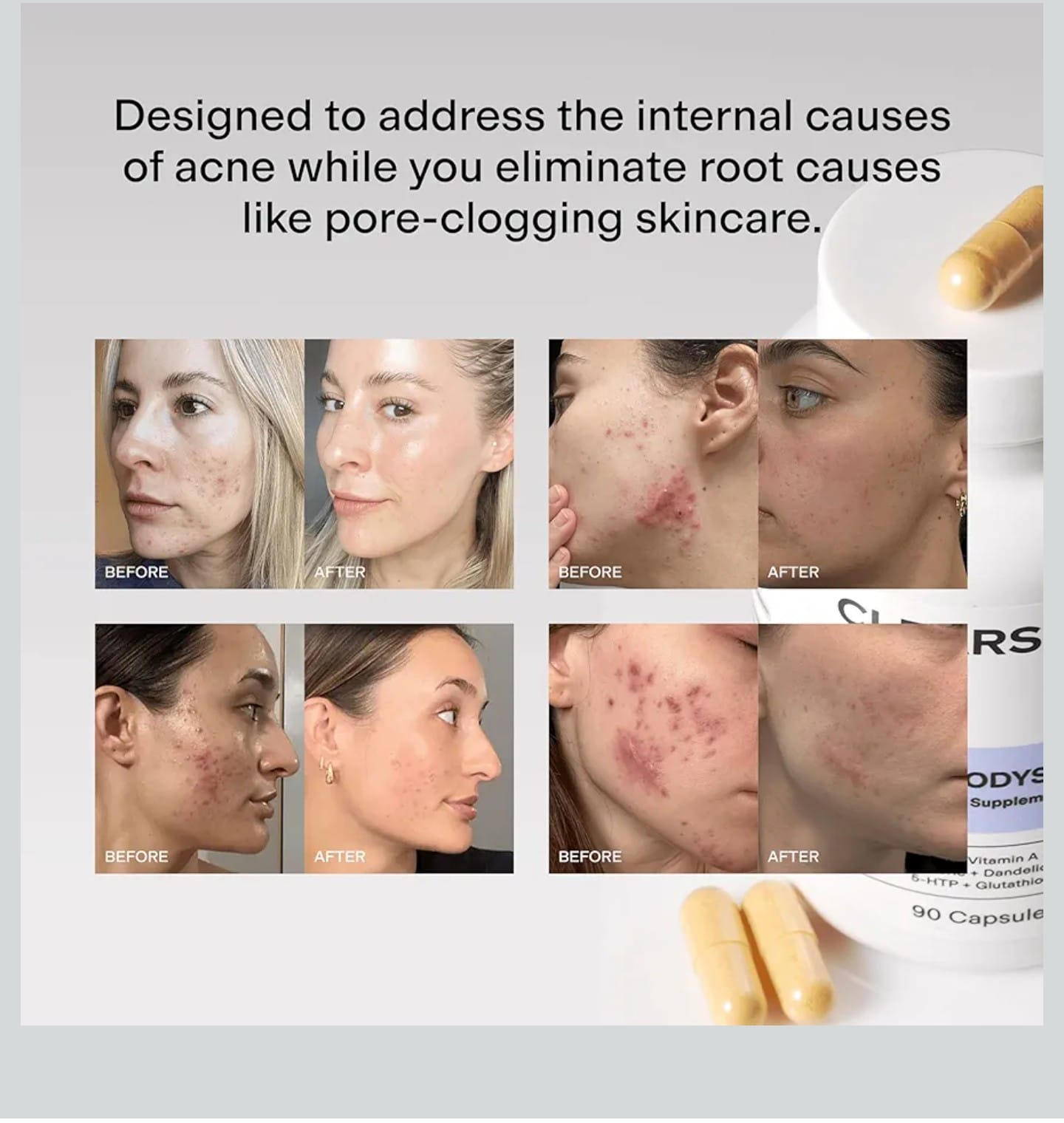 Hormonal Acne Supplement